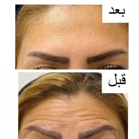 خدمات ژل بوتاکس آنزیم فیلر جوانساز مرو سر ابرو|خدمات آرایشگری و زیبایی|چهارباغ, |دیوار