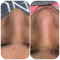 پاکسازی و فیشال پوست