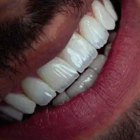 کامپوزیت دندان،دندانپزشکی،اطفال،عصبکشی