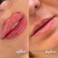 ژل بوتاکس آفر ویژه بوتاکس فقط ۷۵۰ با ترمیم رایگان