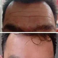 جشنواره ویژه تزریق ژل و مزو و پی آرپی درمطب|خدمات آرایشگری و زیبایی|اصفهان, نقش جهان|دیوار