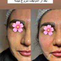 درمان افتادگی غبغب بازو وشکم وصورت|خدمات آرایشگری و زیبایی|قم, سالاریه|دیوار
