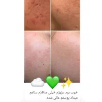 سفید کننده ضدلک اصل تضمینی حاوی گلوتاتیون بشدت قوی|آرایشی، بهداشتی، درمانی|بم, |دیوار