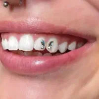 کاشت نگین دندان توسط دندانپزشک/ ضدحساسیت