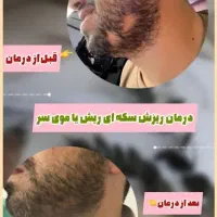 درمان ریزش سکه‌ای ریش و مو با کمترین هزینه یک جلسه