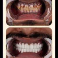 کامپوزیت لبخندی دوباره