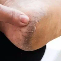 با ترک و زبری پات خدافظی کن