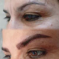 میکروبلیدینگ