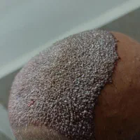 کاشت مو و ابرو|خدمات آرایشگری و زیبایی|جوانرود, |دیوار