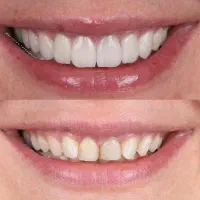 بیمار زیبایی لمینیت برای دوره دندانپزشکی