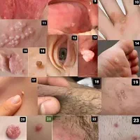 رفع ریشه ای زگیل و تبخال تناسلی