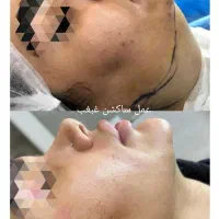 جشنواره بلفاروپلاستی پلک غبغب سانترال ژل چربی|خدمات آرایشگری و زیبایی|قم, بلوار امین و ساحلی|دیوار