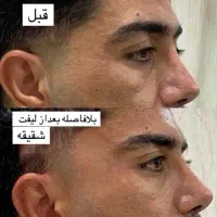 زیبایی لیفت بلفارو فرم بینی بوتاکس نخ ابروزاویه ژل
