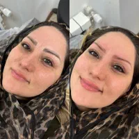 مدل رایگان‌پاک کردن تتوخط چشم لیزرتتو|خدمات آرایشگری و زیبایی|تهران, اقدسیه|دیوار