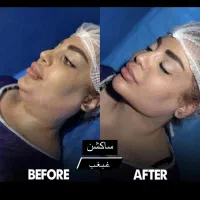 لیپوساکشن غبغب با ویزر و اندولیفت توسط جراح تضمینی|خدمات آرایشگری و زیبایی|مشهد, راهنمایی|دیوار