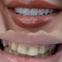 کامپوزیت زیبایی دندان  اهواز