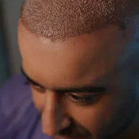 کاشت تخصصی مو به روش FIT|خدمات آرایشگری و زیبایی|رشت, گلسار|دیوار