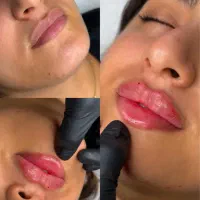 جشنواره تابستانه فیلر بوتاکس مزو بادی از ۱۸۰ هزار