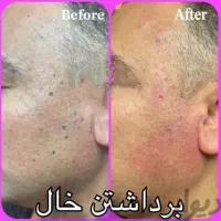 برداشت خال زگیل میخچه ختنه در مطب|خدمات آرایشگری و زیبایی|قم, هفت تیر|دیوار