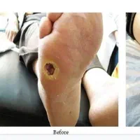 تزریقات سرم سوند پانسمان زخم بستر پای دیابتی|خدمات آرایشگری و زیبایی|تبریز, |دیوار