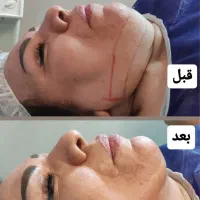 لیپو۴۵میلیون ابدو۶۵م باشرایط اقساط ساکشن غبغب۹۸۰۰