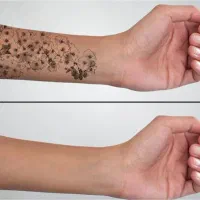 لیزر رفع تتو و کک مک، روشن سازی بدن، لیزر مو زائد