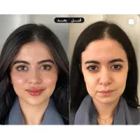 فیلرگونه/فیلرچانه/کانتورینگ فقط چهارشنبه