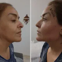 تزریق چربی ، فیلر بادی، ژل، بوتاکس در مطب|خدمات آرایشگری و زیبایی|شیراز, گویم|دیوار
