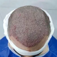 کاشت مو چهرهvip|خدمات آرایشگری و زیبایی|تهران, ونک|دیوار