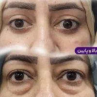 بلفاروپلاستی ( شوش ، اهواز ، شوشتر )