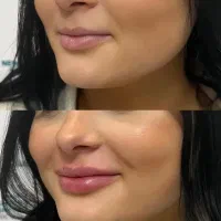 جشنواره  یلدایی تزریق ژل فقط و فقط هر سیسی ۱ ملیون|خدمات آرایشگری و زیبایی|همدان, |دیوار