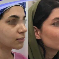 تزریق چربی به‌صورت قزوین