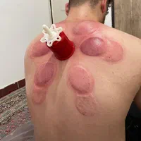 کسالت وخستگی بدن خودرابا حجامت برطرف کنید|خدمات آرایشگری و زیبایی|ایلام, |دیوار