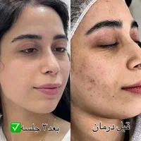 پاکسازی تخصصی پوست با تخفیف ویژه