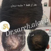 درمان ریزش مو توسط پزشک|خدمات آرایشگری و زیبایی|قم, دورشهر|دیوار