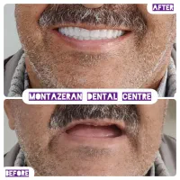 دندانسازی دندانساز دندان مصنوعی دندان باضمانت|آرایشی، بهداشتی، درمانی|مشهد, کوشش|دیوار