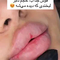 تزریق ژل اصل با قیمت هر سی‌سی فقط ۶۰۰