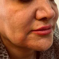 درمان افتادگی غبغب بازو وشکم وصورت|خدمات آرایشگری و زیبایی|قم, سالاریه|دیوار