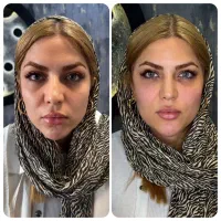 جشنواره لیفت تخصصی صورت با نخ و کانتورینگ