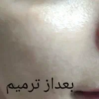 مزو تراپی|خدمات آرایشگری و زیبایی|مشهد, کارگران|دیوار