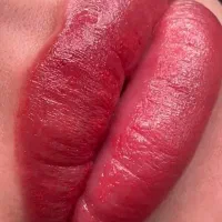 میکروبلیدینگ،میکروپیگمنتنشن.ریمو.آنزیم