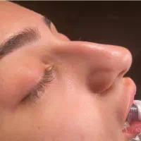 عمل/بینی/ جراحی زیبایی/بدون تامپون/اقساطی|خدمات آرایشگری و زیبایی|کرج, عظیمیه|دیوار