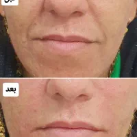 تزریق فیلر وبوتاکس وجوانساز صورت