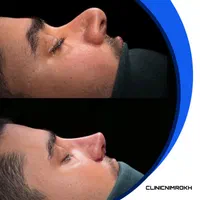 آخرین مهلت عمل بینی|خدمات آرایشگری و زیبایی|تهران, نظامی گنجوی (توانیر)|دیوار