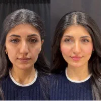 جشنواره یلدایی ژل / بوتاکس / جوانساز صورت(در مطب)|خدمات آرایشگری و زیبایی|شاهین‌شهر, فردوسی|دیوار