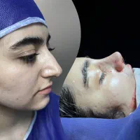 عمل زیبایی بینی در تهران