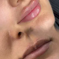 تزریقات زیبایی کلینیک زیبایی لاراتیس|خدمات آرایشگری و زیبایی|یاسوج, |دیوار