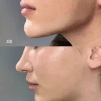 خدمات تزریق تخصصی ژل ،فیلر و بوتاکس و آنزیم|خدمات آرایشگری و زیبایی|سبزوار, جنت|دیوار
