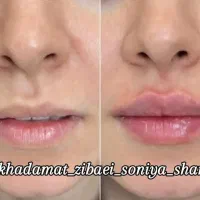 تخفیف ویژه ژل و بوتاکس تا یک هفته|خدمات آرایشگری و زیبایی|اهواز, منبع اب|دیوار