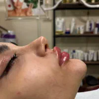 خدمات تزریق ژل ،بوتاکس و لاغری تضمینی